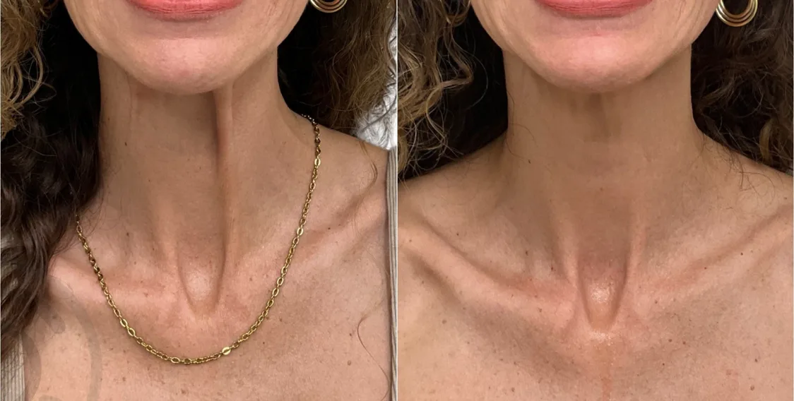 Botox Cuello
